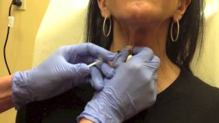 Botox for Platysmal Bands on Neck [upl. by Gloriane]