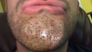 What Are Chin Pimples Ear Blackheads and Nose Whiteheads [upl. by Suryt648]