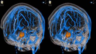 Acoustic Neuroma  3D Virtual Tour  UCLA Neurosurgery [upl. by Dnalhsa]