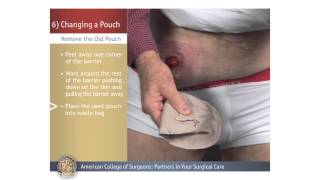 ColostomyIleostomy Changing a Pouch [upl. by Anniahs229]