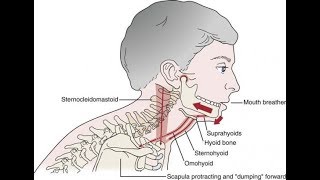 A common cause of TMD Suprahyoid muscle clenching [upl. by Purity]