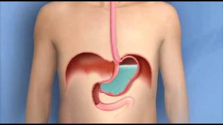 GastroEsophageal Reflux Disease GERD  Dr Gary Sy [upl. by Perretta]