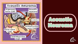 Acoustic Neuroma [upl. by Nanci]