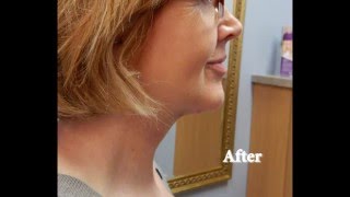 Learn about neck rejuvenation with platysmaplasty [upl. by Auoz]