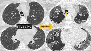 Understanding Bronchiolitis [upl. by Gwen862]