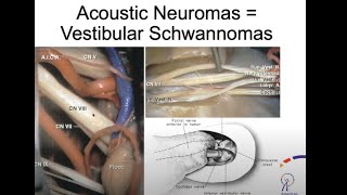 A Rare Brain Tumor Affecting Hearing amp Balance  Acoustic Neuroma [upl. by Carman610]