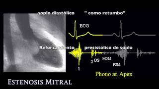 Auscultación de la Estenosis Mitral [upl. by Otto857]