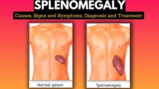 Splenomegaly Causes Signs and Symptoms Diagnosis and Treatment [upl. by Mulderig]