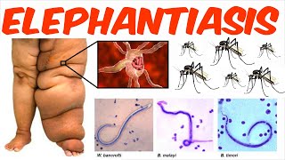 Lymphatic Filariasis  Elephantiasis [upl. by Jenkins528]