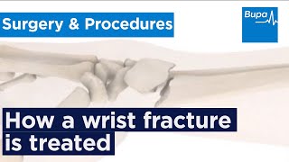 How a wrist fracture is treated  Bupa Health [upl. by Boylan]